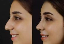 Discover the Beauty of Rhinoplasty in Dubai: Transform Your Look Today!