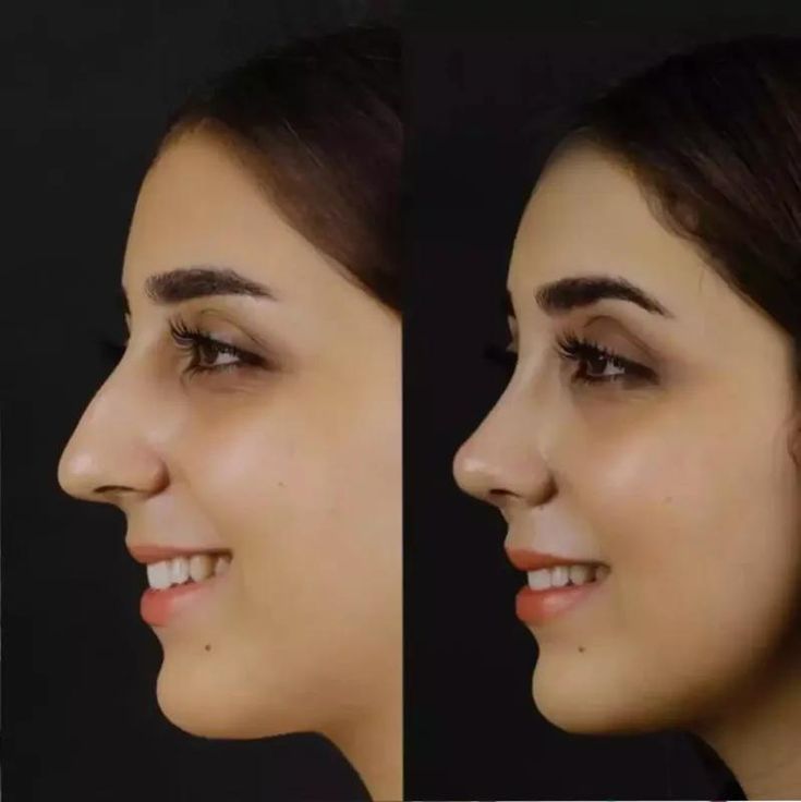 Discover the Beauty of Rhinoplasty in Dubai: Transform Your Look Today!