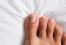 Fungal Nails