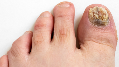 How to Heal a Toe Infection Caused by Ingrown Nails