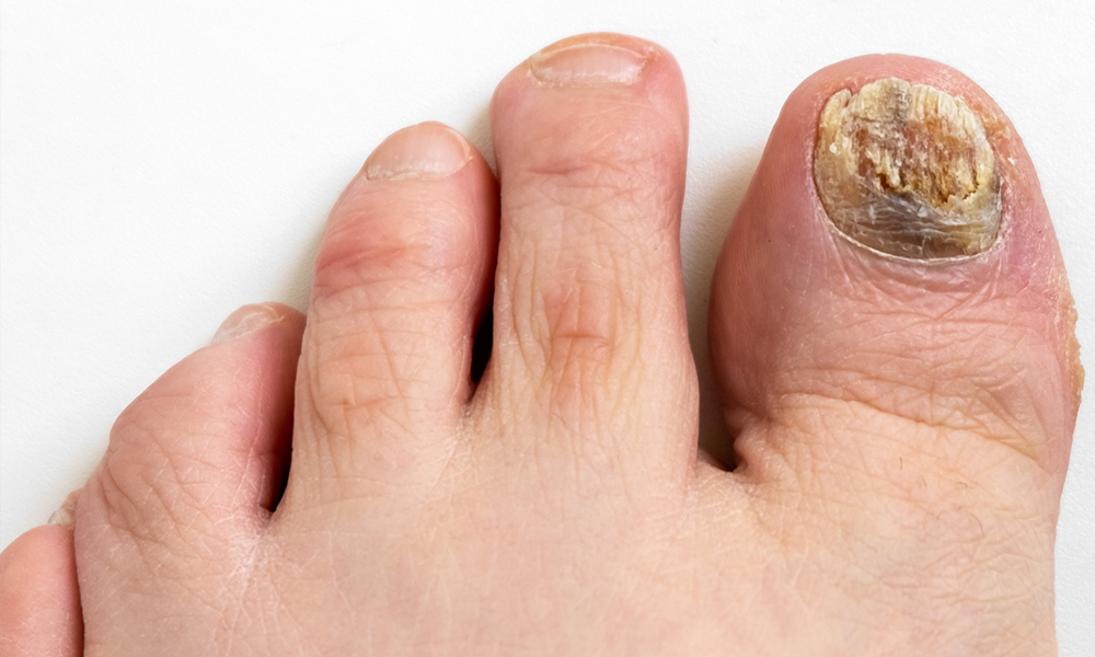 How to Heal a Toe Infection Caused by Ingrown Nails