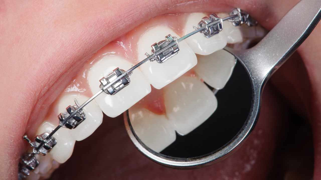 Manhasset Braces: A Comprehensive Guide to Straightening Your Smile