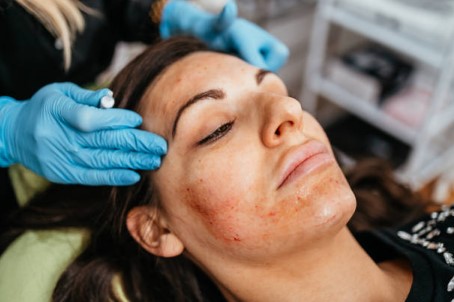 Who Can Benefit From PRP Facial Treatments In Tucson