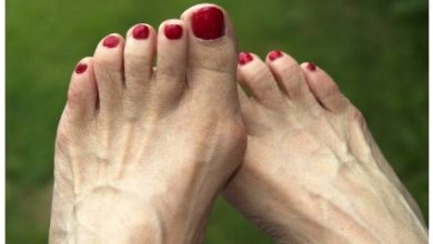 Why Bunion Surgery May Be the Solution to Your Foot Pain