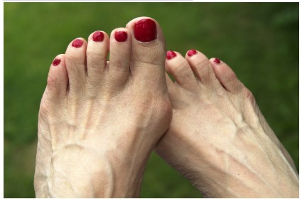 Why Bunion Surgery May Be the Solution to Your Foot Pain